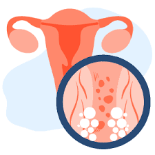 Gejala dan tanda menghidap kanser ovari. Waspadai 3 Gejala Fibroid Rahim Atau Tumor Jinak Rahim Ini