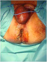 It commonly occurs in older men, but it can also occur in women and children. A Severe Case Of Fournier S Gangrene With Excessive Erythema And Edema Download Scientific Diagram