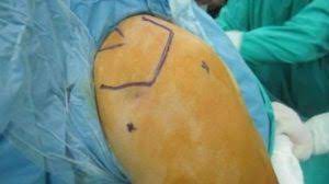 kapali omuz ameliyati op dr taner bekmezci