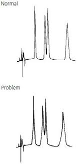 Maybe you would like to learn more about one of these? Hplc Troubleshooting Guide