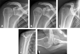 Open conjoint tendon release was performed by the senior author from june 2014 to november 2018 in patients with persistent anterior shoulder pain after rtsa. Shoulder Anatomy And Normal Variants