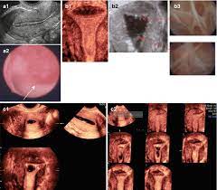 People who have had polyps in the past are somewhat more likely to develop them in the future, compared to uterine polyps have roughly a 5 percent chance of being related to cancer (malignant), while fibroids have less than a 1 percent likelihood of malignancy.410. Endometrial Polyps Springerlink