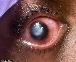 What happens if you sleep with contacts on. Eye Doctor Shares Shocking Photos After Patient Sleeps With Contact Lenses In Daily Mail Online