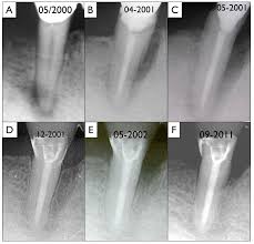 • according to the current classification of periodontal diseases. Https Www Zora Uzh Ch Id Eprint 71559 1 29 Schmidlin Cementaltear Opendentj 2012 Pdf