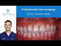Professionelle Zahnreinigung Munchen Pzr Prophylaxe