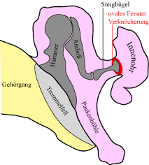 Otosklerose Spezialisten Finden Informationen