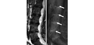 New Marker For Degenerative Disc Disease Disclosed Orthopedics This Week