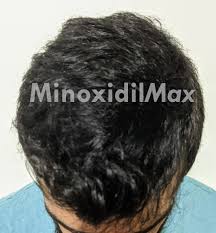 Tretinoin cream has many benefits but also may have some side effects. Minoxidil With Retinoic Acid For Hair Loss Treament Dualgen 5r Available Now