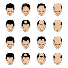 Information Chart Showing Types And Stages Of Hair Loss For Men