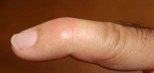 This results in the inability to extend the finger tip without pushing it. Mallet Finger Baseball Finger Orthoinfo Aaos