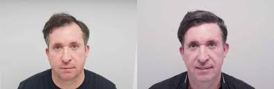 Liverpool FC legend Robbie Fowler issues verdict as he has second hair  transplant