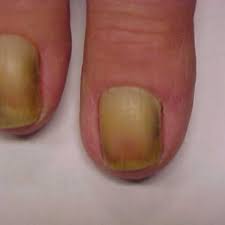 Image result for Yellow nail syndrome feet
