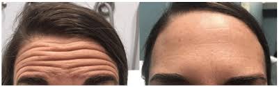 Botox Dallas Anti Wrinkle Injection Plano Rejuve Med Spa