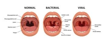 Image result for Strep throat infection roof of mouth