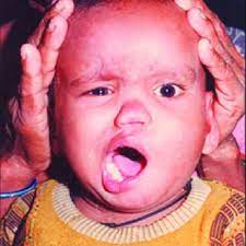 A 6 Month Old Infant Showing Left Side Facial Palsy With Deviation Of Download Scientific Diagram