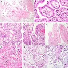Mesothelioma is a malignant tumor that arises from the mesothelial surfaces of the pleural and peritoneal cavities, the tunica vaginalis, . Clinicopathological Characteristics Of Well Differentiated Papillary Mesothelioma Of The Peritoneum A Single Institutional Experience Of 12 Cases In Vivo