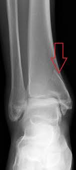 Bimalleolar fracture if elderly or unable to undergo surgical intervention. Ankle Fractures Trauma Orthobullets