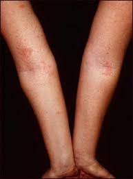 Pin On Occupational Diseases