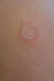 Image result for Eczema nummulare