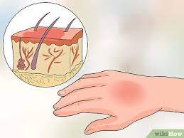 How to treat hot water burn. How To Treat A Hot Water Spill On Your Skin 14 Steps