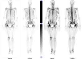 Note, the better you can feel and control your hip. Hip Joint And Femur Metastases As The First Symptom Of Hepatocellular Carcinoma Detected By Bone Scintigraphy Sciencedirect