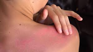 Image result for Sunburn