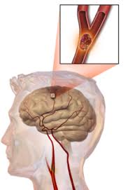 Knowing the signs of a stroke is the first step in stroke prevention. Stroke Wikipedia