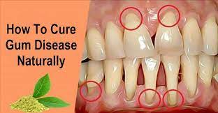 Gingivitis Which Is Manifested With An Inflammation Of The Gum Tissue Is A Common Health D Gum Recession Treatment Gum Disease Treatment Gum Disease Remedies