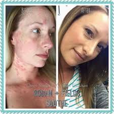 A Case of Auto immune disorder with oozing pus and fluid filled superficial  skin layer untreatable for many years with many drugs and steroids. Was  treated for 1 month through Naturopathic way