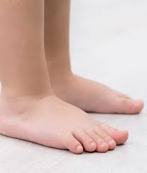 Image result for Out-toeing