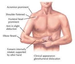 Image result for Shoulder Relocation Maneuvers