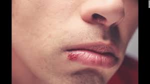 Five Diseases You Can Get From Kissing