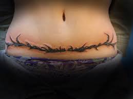 Tatuajes Medicos Cicatrices Mastectomias Alopecia Etc Belagoria La Web De Los Tatuajes