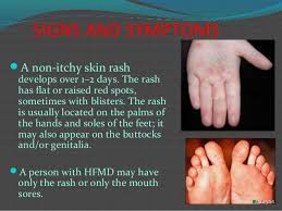 Asked for female, 5 years 21 views v. Hand Foot And Mouth Disease Hfmd Ris Clinic