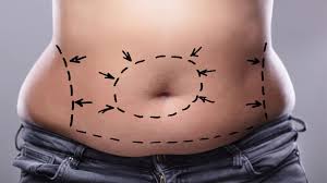 Karin Germe Ameliyati Health Beauty Travel