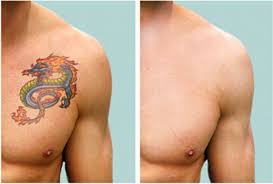 Tattoo removal before and after photos. Tattoo Removal Before And After