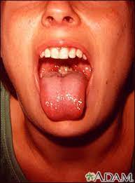 Most people are infected by the virus as children, when the disease produces few or no symptoms. Mononucleosis Mouth Medlineplus Medical Encyclopedia Image
