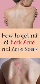 Here are 15 natural home remedies to get rid of acne scars fast: Pin On Hair Skin Care