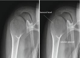 Image result for Shoulder Imaging