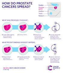 Chemotherapy, most commonly with the drug docetaxel. Migration Settlement And More Migration How Prostate Cancers Spread Cancer Research Uk Cancer News