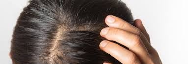 It might even make you scratch your scalp which happens because of scaling. How To Check For Scalp Psoriasis Vanguard Dermatology