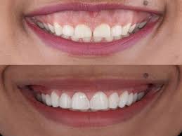 How to fix a gummy smile with braces. Gummy Smile Treatment Delhi India Cost Of Gummy Smile Correction Delhi India