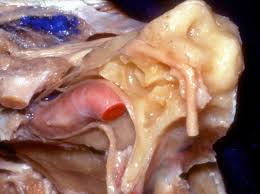 Less commonly, an inner ear infection is a true infection caused by a virus or bacteria. Interior View Of The Petrous Temporal Bone And Inner Ear Neuroanatomy The Neurosurgical Atlas