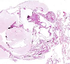 Peritoneal cystic mesothelioma is a rare benign tumor characterized by the formation. Pathology Outlines Multicystic Mesothelioma