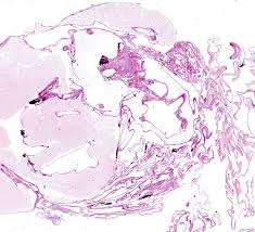 Mesothelioma, though, is often associated with exposure to asbestos or asbestos. Pathology Outlines Multicystic Mesothelioma