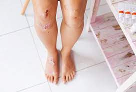 Petroleum jelly prevents the wound from drying out and forming a scab; Cuts Scrapes Puncture Wounds Care Symptoms Antibiotics