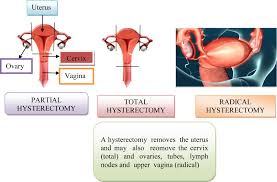 For patients without previous subtotal hysterectomy. Frontiers Cervical Cancer Different Treatments And Importance Of Bile Acids As Therapeutic Agents In This Disease Pharmacology