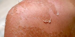 Impetigo is a type among kids. Skin Peeling How To Stop It And Protect Yourself From Sunburns Insider