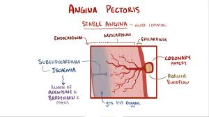 It could be used to describe those with frequent attacks of to differentiate between unstable angina and non st elevtion myocardial infarction u have to order. Angina Pectoris Osmosis