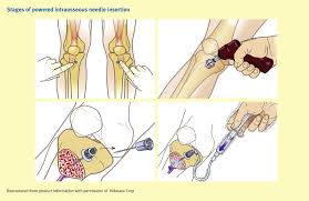 Image result for Difficult Intravenous Access in Children